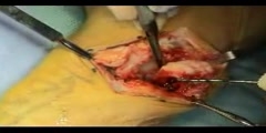 Ulnar head excision (Darrach procedure)