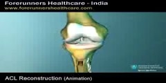 Anterior Cruciate Ligament  ACL Reconstruction Surgery in India