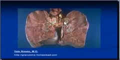 Sarcoidosis