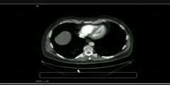 Characteristics of Pulmonary Embolism