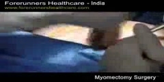 Abdominal myomectomy - India