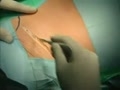 Open Inguinal Hernia Repair Surgery Diagnosis and Treatment