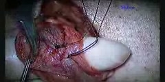 Microsurgical varicocelectomy for varicocele operation