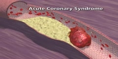 Pathophysiology of Coronary Artery Disease