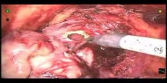 Robotic Simple Prostatectomy Video