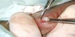 Vasectomy inline with ILV instruments