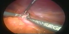 Mini Gastric Bypass Operation Surgery Video
