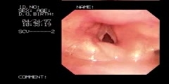 Fiberoptic Laryngoscopy explained