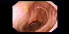 Colonoscopy - Normal