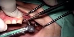 Unsuccesful Dental Implant