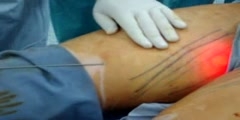 Demo of Liposuction Procedure done in Qatar