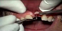 Dental Implant Surgery Failure