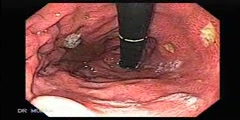 Multiple Case of  Ulcers