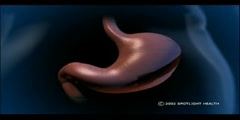 Laparoscopic Gastric Band Surgery Animation
