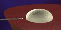 Radiofrequency ablation of HCC animation