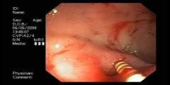 Occurrence relapse of bleeding from duodenal ulcer