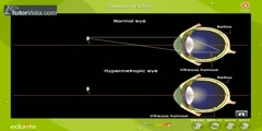 Characteristics Of Hypermetropia