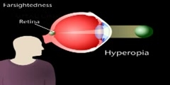 Hyperopia- Defect in Eyes