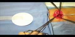 Soft simple painless surgical repair of umbilical hernia