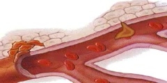 How Metastasis Travel In The Body