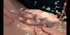 Tumor Neovascularization