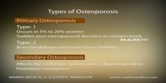 Osteoporosis  - Scientific Video and Animation Site