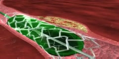 Stent deployment Medical Animation Scientific animation