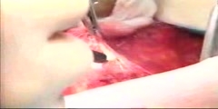 Mastectomy Procedure