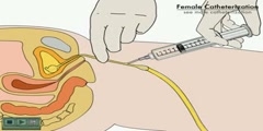 NurseReview.Org - Animation on Catheterization