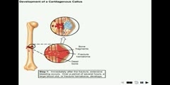 NurseReview.Org - Animation on Fracture Repair