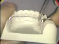 Immediate anatomic zirconia upper molar dental implant