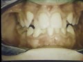 Lec 6 - Care of Oral Tissues During Orthodontic Therapy