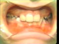 Lec 61-Constructing a Removable Partial Denture Part III