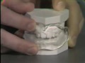 Lec 27 -Oral Shield As a Habit-Control Orthodontic Appliance