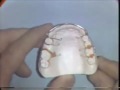 Lec 28 - Orthodontic Acrylic Technique