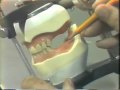 Lec 10 - Setting Posterior 20 Versus 0 Degree Artificial Teeth