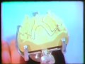 Lec 15 - Rotational Path Concept in Removable Partial Dentures