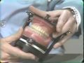 Lec 30 - Remounting the Processed Complete Denture