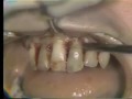 Lec 49  - Delivery of Immediate Maxillary Complete Denture