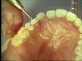 Lec 52 - Preparation of Immediate Denture for Delivery