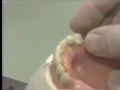 Lec 55 - Setting Posterior Teeth
