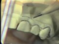 Lec 69-Setting Anterior Teeth for Immediate Maxillary Denture