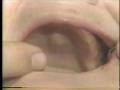 Lec 70-Edentulous Maxillary Alginate Impression Technique