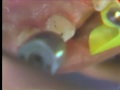 Lec 81 - Preparation of an Anterior Pinledge Bridge