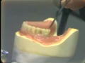 Lec 83 - Setting Posterior 0 Versus 0 Degree Artificial Teeth