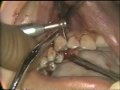 Lec 50 - Mucoperiosteal Flap Design and Surgical Removal of Teeth