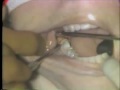 Lec 10 - Horizontal Mandibular Impaction and Maxillary Third Molar