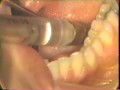 Lec 46  - Functional Waxing Procedure for Mandibular Technique Bridge