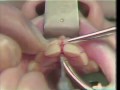 Lec 15 - Diastema Closure and Frenectomy With Z-Plasty