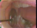 Lec 16 - Impaction of Third Molars